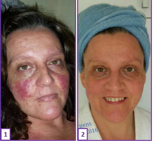 Ganzheitliche Heilung der Haut am Beispiel der Rosacea